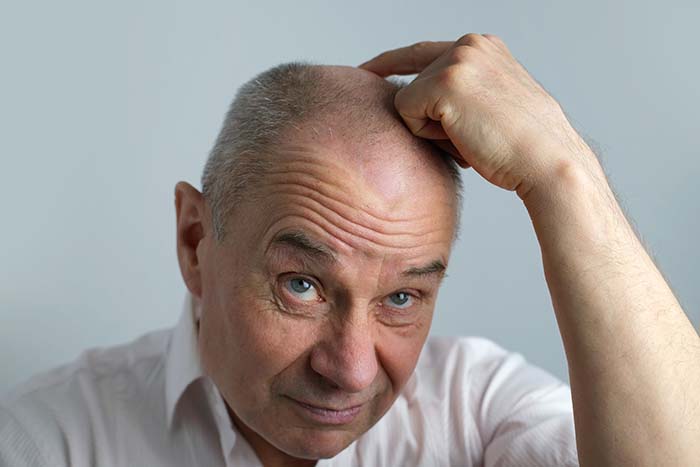 Causes des chutes de cheveux chez un homme