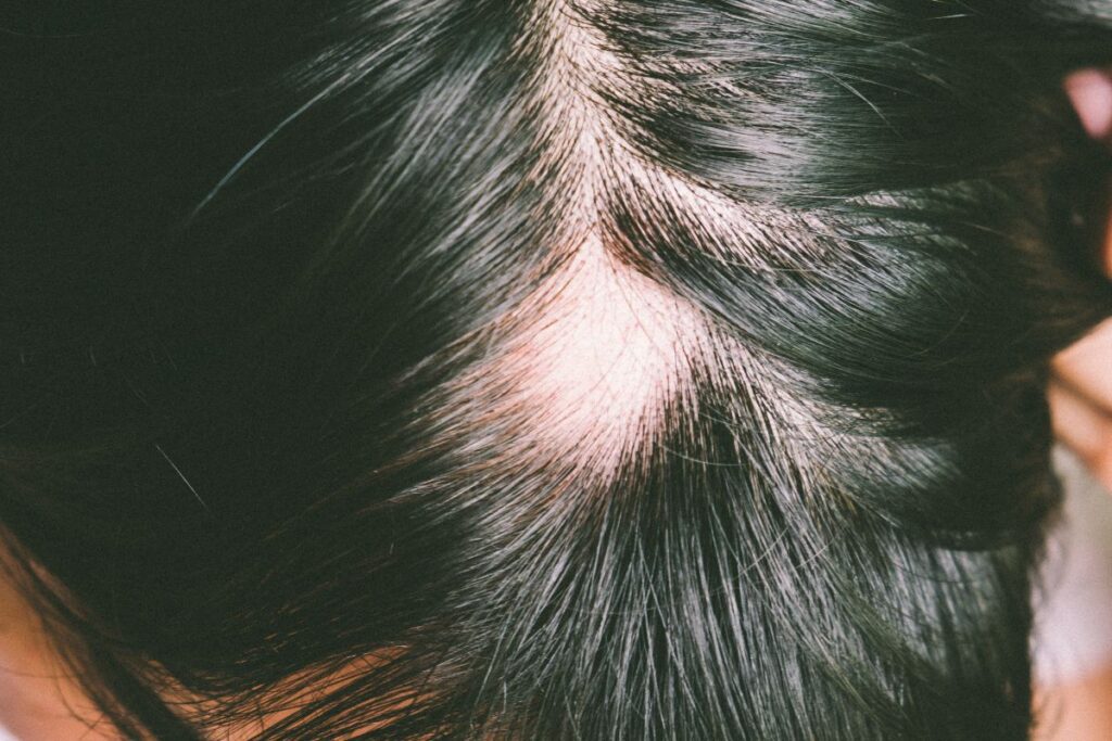 que faire contre alopecie femme